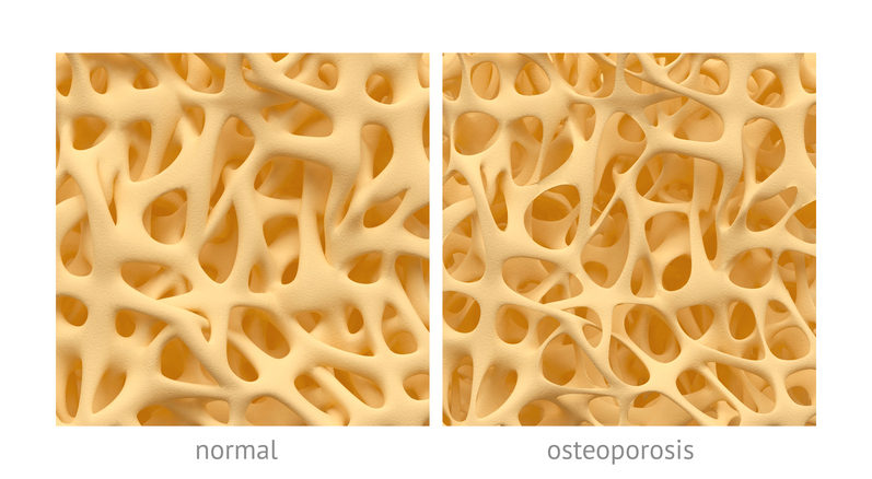 os cu structură normală și cu structură în osteoporoză